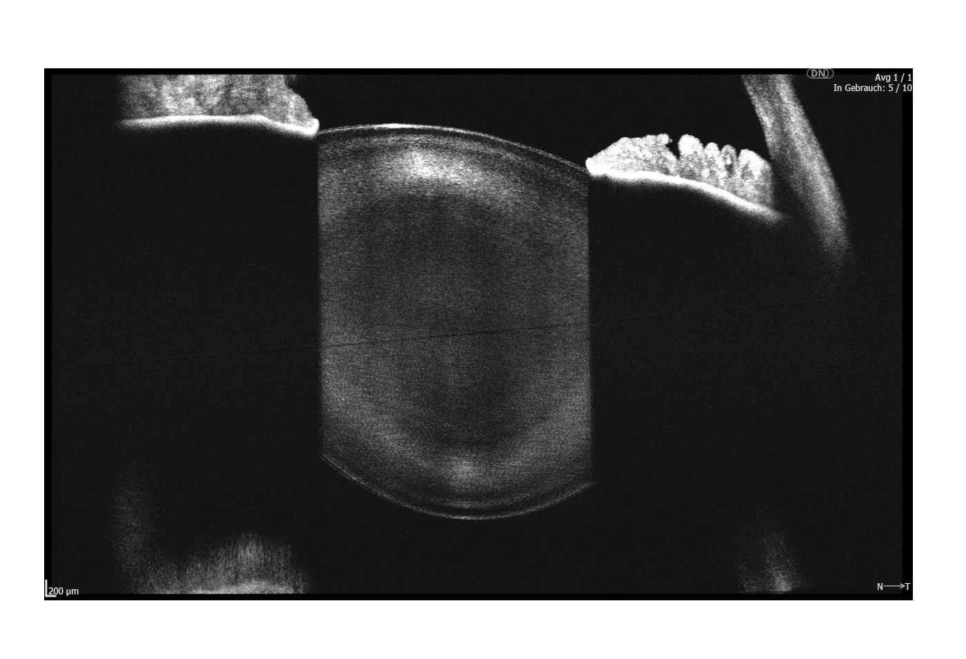 Biometrie_IOL_Abbildung 3.2.jpg