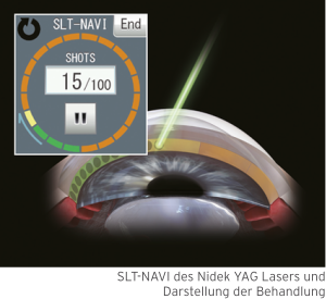 Abbildung 1: SLT-NAVI des Nidek YAG Lasers und Darstellung der Behandlung
