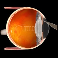Volk Blumenthal Iridotomy Lupe – schwarz/mit individueller Gravur