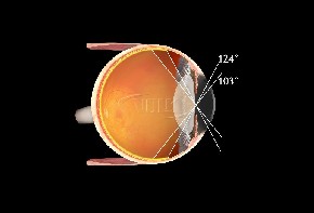Volk Super Vitreo Fundus Lupe - schwarz / mit individueller Gravur