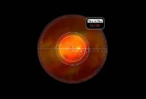 Super Macula 2.2 Volk Kontaktglas - schwarz/ ohne Gravur