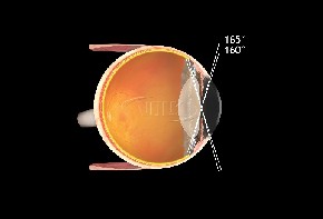 Volk indirektes Kontaktglas Super Quad 160 - schwarz/ohne Flange