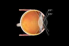 Volk PDT Laser Lupe Photo Dynamische Therapie - schwarz/mit individueller Gravur