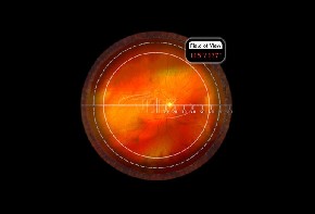Volk PDT Laser Lupe Photo Dynamische Therapie - schwarz/mit individueller Gravur