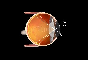 Volk indirektes Kontaktglas Area Centralis - schwarz / mit Gravur/ ohne Flange