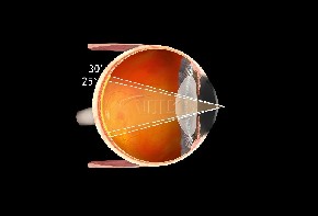 Volk Fundus Laser Kontaktglas 20mm Skleralrand - schwarz/ indiv. Gravur möglich