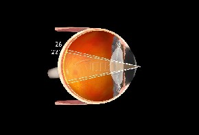 Volk Centralis Direct Kontaktglas - schwarz/ mit ANF+/ ohne Gravur