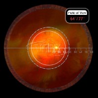 Volk ind. vitreo Kontaktglas Super Macula