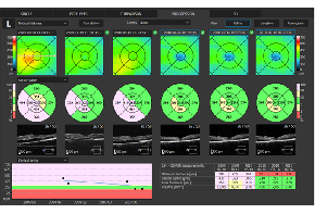 SD-OCT Copernicus REVO NX130