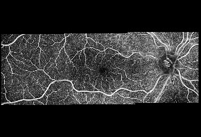 REVO Angio-Modul