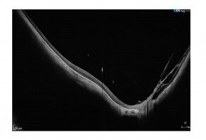 Copernicus REVO Biometrie & IOL